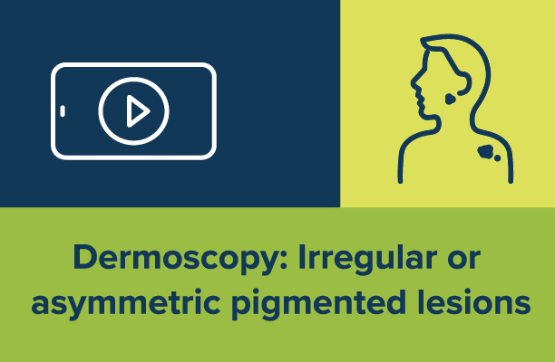 Dermoscopy: Irregular or asymmetric pigmented lesions