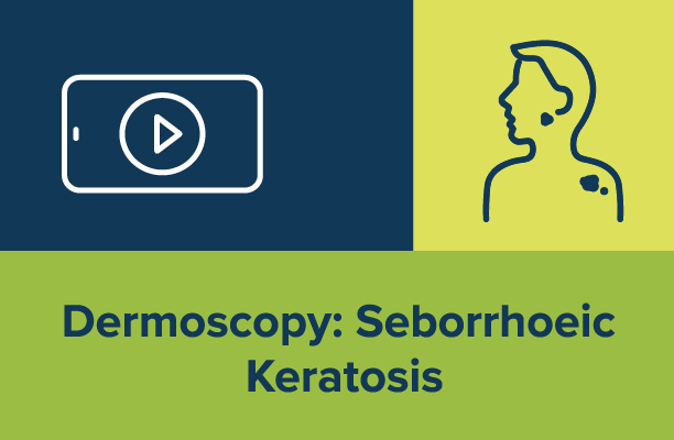Dermoscopy: Seborrhoeic Keratosis