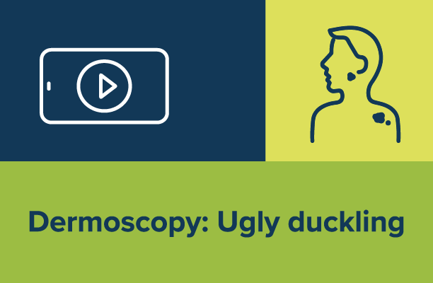 Dermoscopy: Ugly duckling