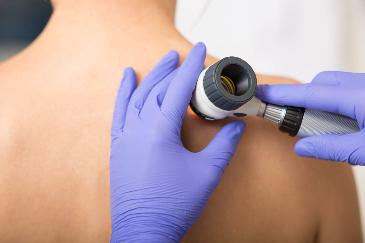Healthcare professional examining patient's mole with a dermatoscope.